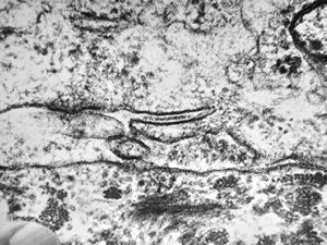 M,7m. | histiocytosis X (eosinophilic granuloma) … formation of Birbeck body M,7m. | histiocytosis X (eosinophilic granuloma) … formation of Birbeck body